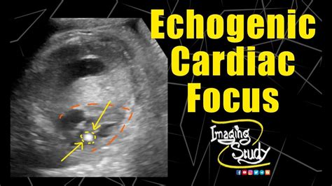 ultrasound for echogenic focus